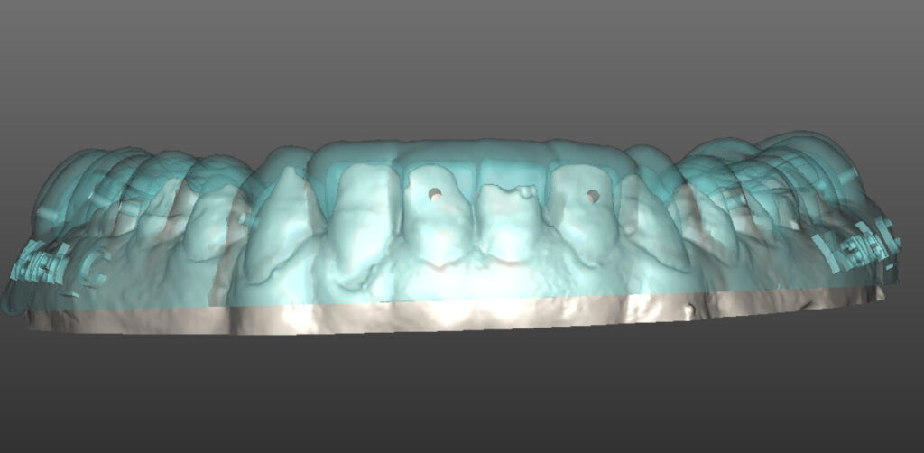 GBR (irányított csontregeneráció), Khoury technika 3