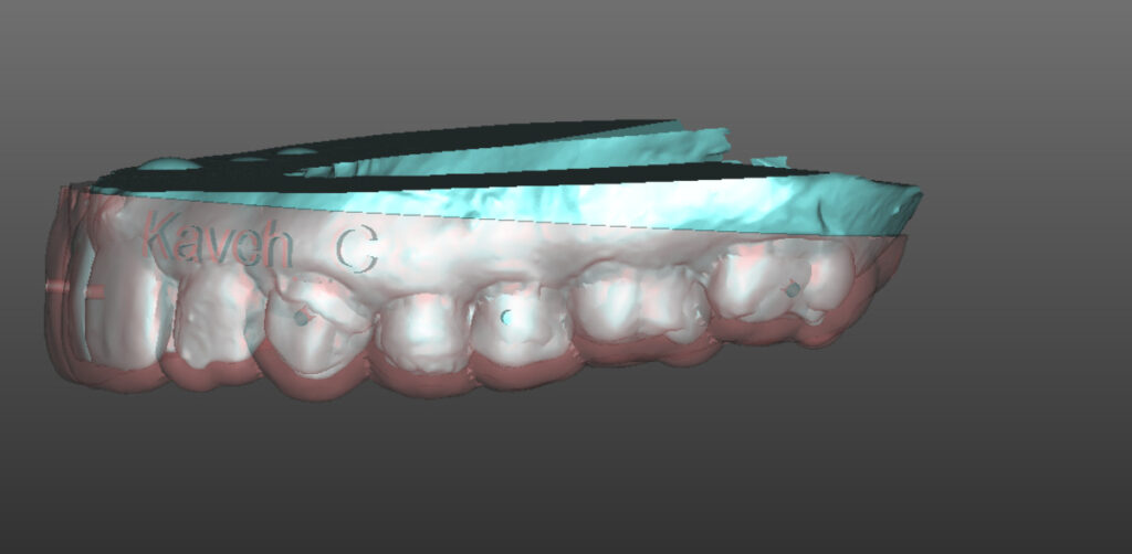 GBR guided bone regeneration Khoury technique-7
