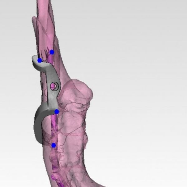 Orthognathic BSSO (bilateral sagittal split osteotomy) surgical guide (1)