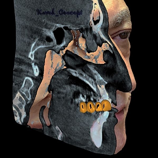 Proguide dental digital planning