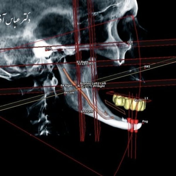 Proguide dental surgical guide design
