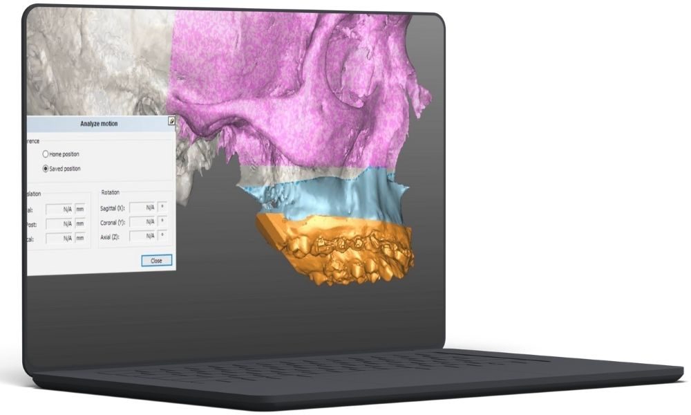 Digital Implant Planning 1