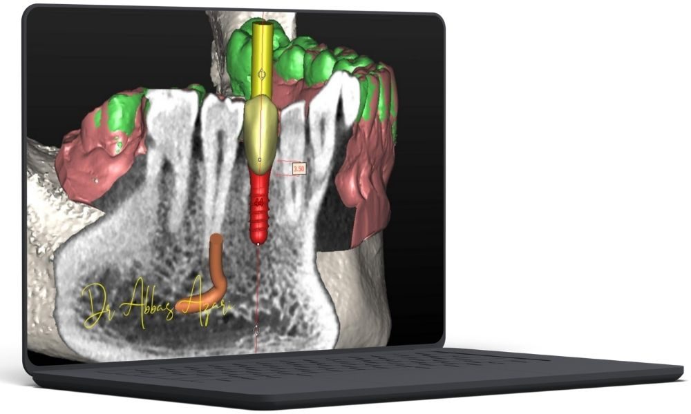 Tooth Supported Surgical Guide